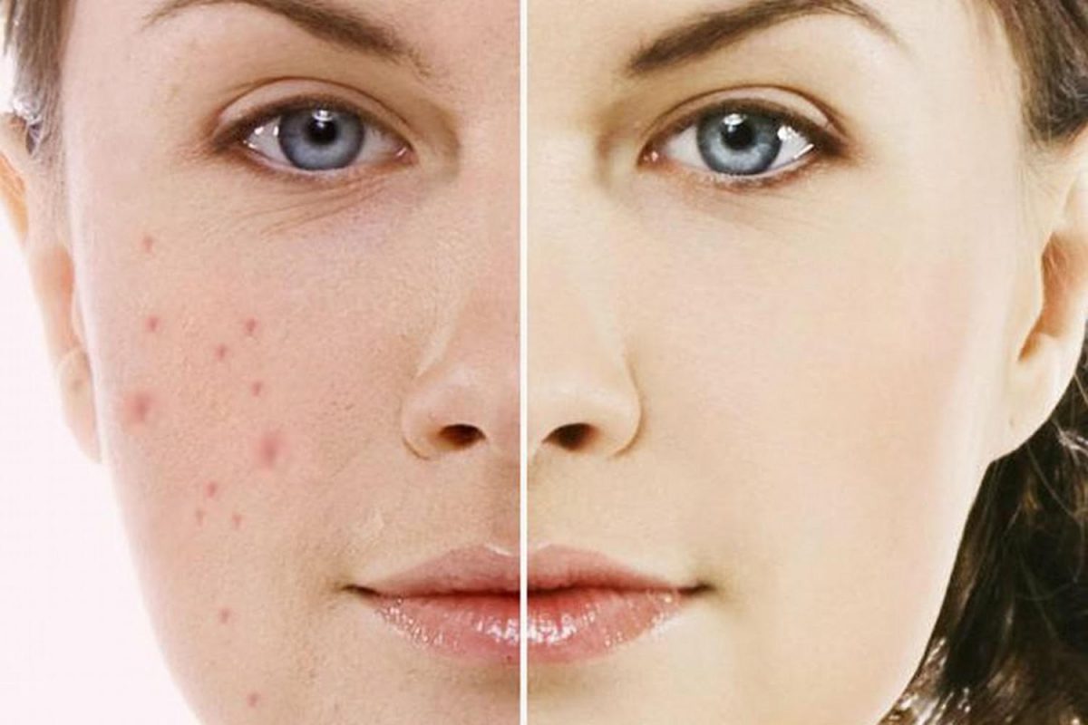 Cách trị vết thâm trên da mặt từ thiên nhiên