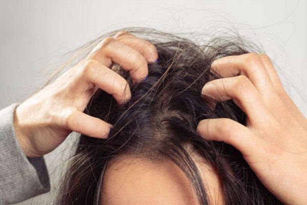 Giải quyết vấn đề với 10 cách trị ngứa da đầu bằng thiên nhiên hiệu quả
