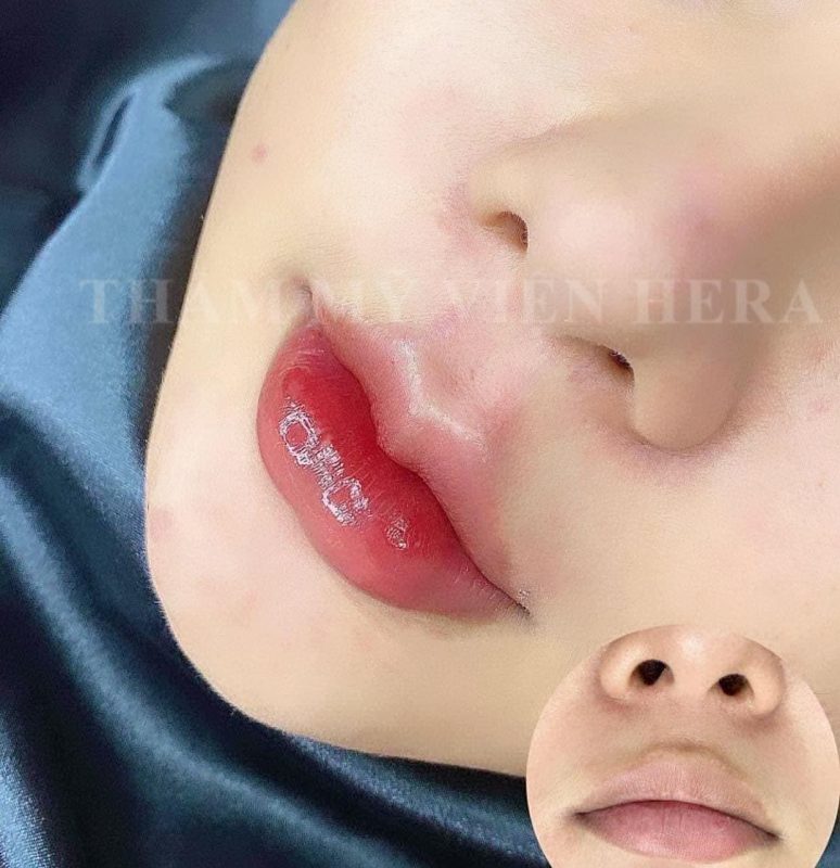 Địa Chỉ Tiêm Filler Uy Tín Ở Đà Nẵng