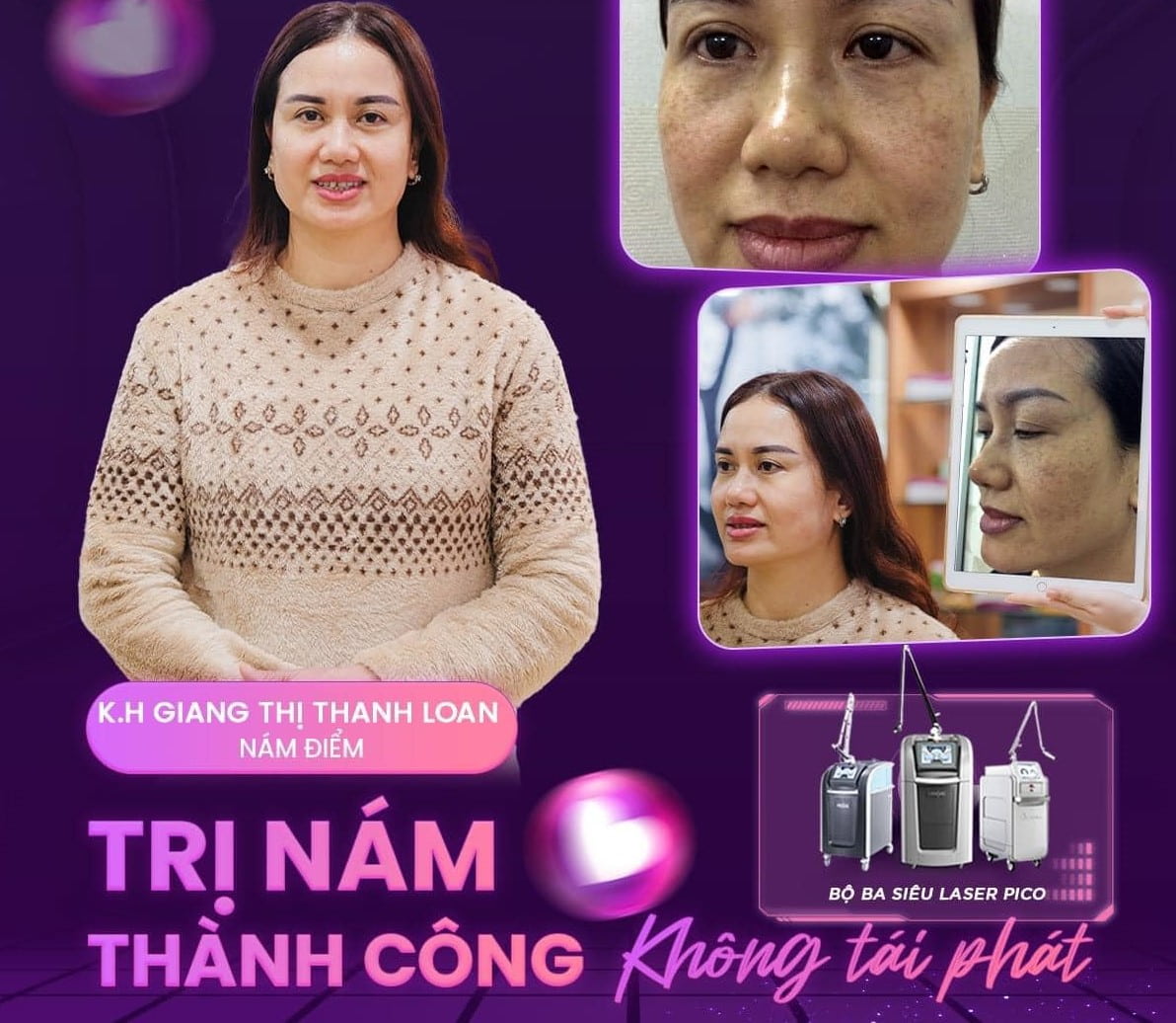 điều trị nám hà nội