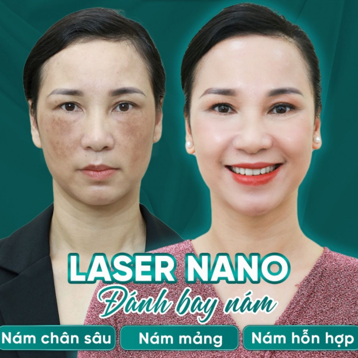 điều trị nám hà nội