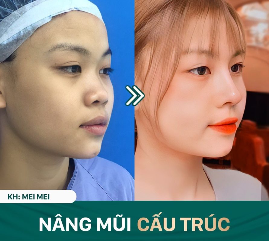 Nâng Mũi Uy Tín Tại Hà Nội