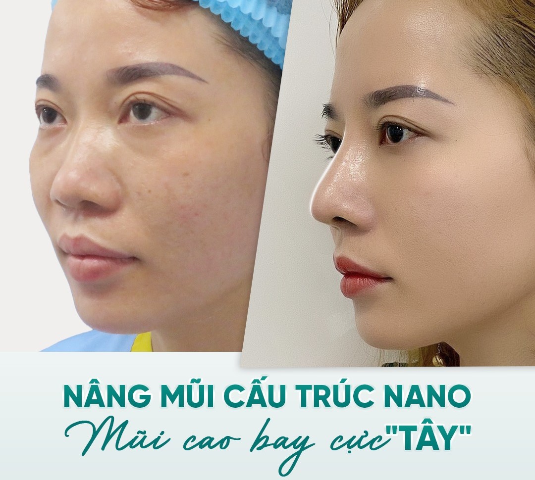 Nâng Mũi Uy Tín Tại Hà Nội