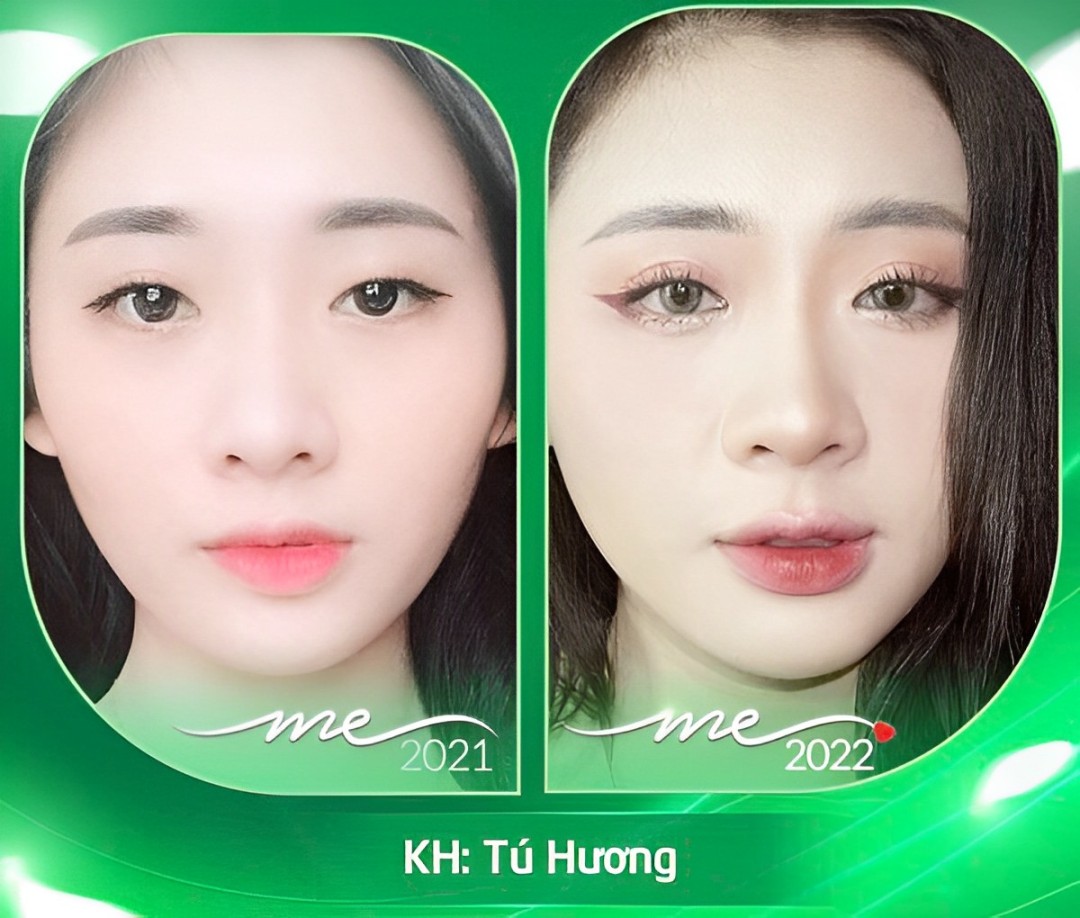 Địa chỉ tiêm filler uy tín tại Hà Nội