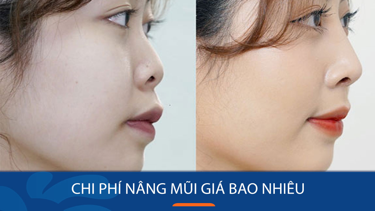 nâng mũi đẹp tại Đà Nẵng